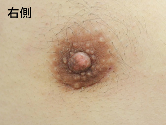 症例