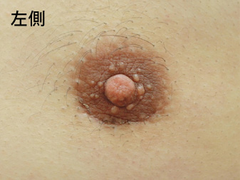 症例