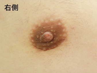 症例