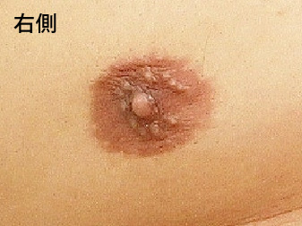 症例