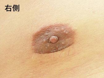 症例