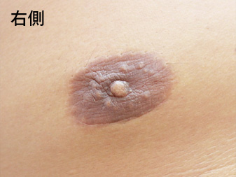 症例