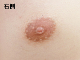 症例