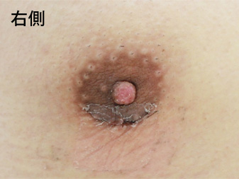 症例