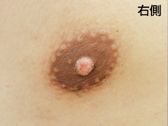 症例