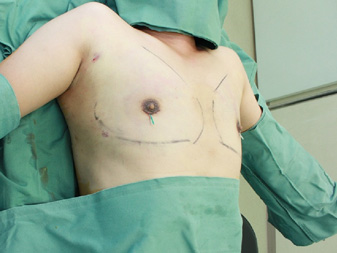 症例