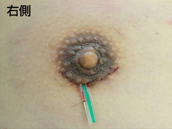 症例