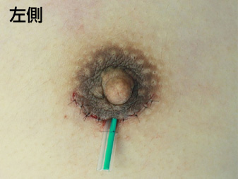 症例