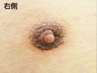 症例