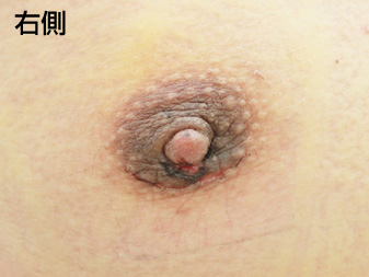 症例