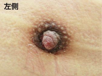 症例