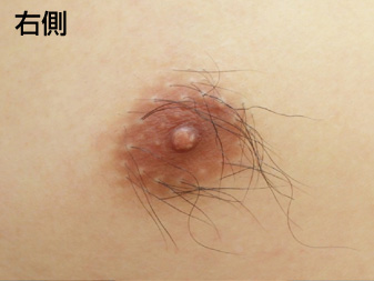 症例