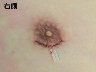 症例