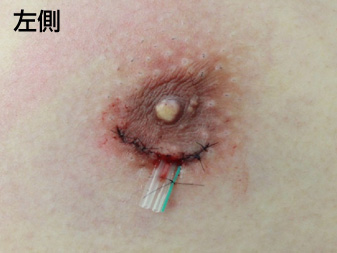症例