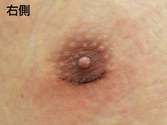 症例