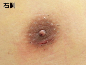 症例