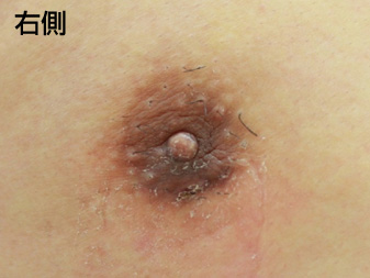 症例