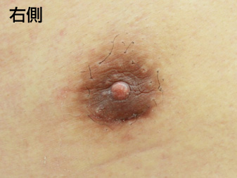 症例