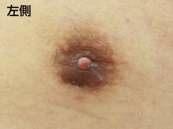 症例