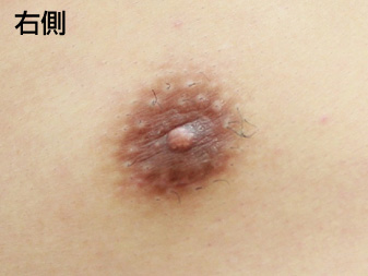 症例