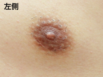 症例