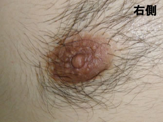 症例