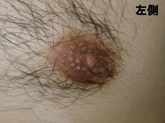 症例