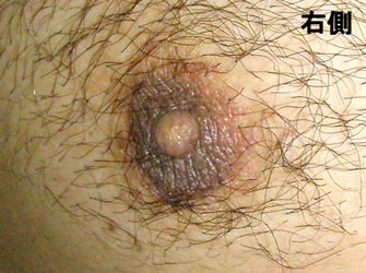 症例